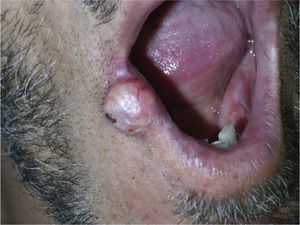 Nodule of 1.5cm diameter infiltrating the lower lip.