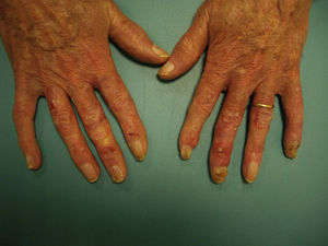Clinical image after treatment with imiquimod cream, 5%.
