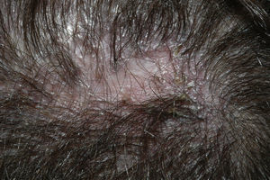 Lichen planopilaris. Detail photograph. Note the follicular hyperkeratosis and atrophic scarring in the center.