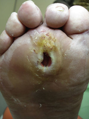 Ulcer in a diabetic foot. The area under the metatarsal heads is the most common location for ulcers in the feet of patients with diabetes. Courtesy of Enric Giralt and Elena Planell.