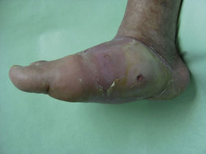 Charcot arthropathy. The destruction of the tarsal and tarsometatarsal joints has led to the loss of the plantar vault. Courtesy of Enric Giralt and Elena Planell.