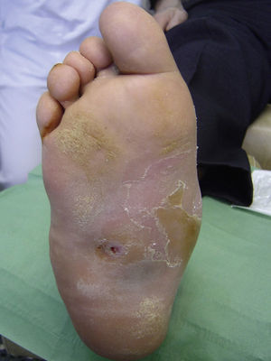 Plantar ulcer in a foot with Charcot arthropathy. The loss of the medial concavity of the foot shown here is characteristic of the advanced stages of Charcot arthropathy. Courtesy of Enric Giralt and Elena Planell.