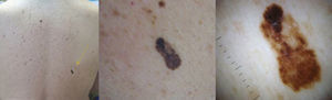 Clinical and dermoscopic appearance of an atypical lentiginous nevus on the back of a 55-year-old man (case 12) that initially prompted clinical suspicion of melanoma.