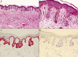 A, Irregular lentiginous epidermal hyperplasia with solitary melanocytes distributed asymmetrically at the dermal-epidermal junction and no dermal nests (hematoxylin-eosin, original magnification ×40). B, Proliferating cells exhibit foci of moderate cellular atypia. Focal pagetoid migration of melanotyes can be observed, with invasion of adnexal structures in some cases (hematoxylin-eosin, original magnification ×200). C, Melan-A immunohistochemical staining reveals the predominance of proliferating melanocytes in the basal layer of the epidermis, with focal pagetoid invasion (Melan-A, original magnification ×100). D, Absence of mitosis and low Ki-67 proliferation index (<5%) (Ki-67, original magnification×100).