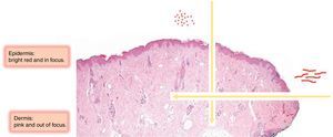 Dermoscopic morphologic features of vessels according to their location in the skin.