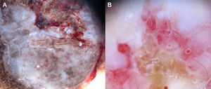 A, Superficial spreading melanoma, Clark level IV and Breslow depth of 3.12 mm, showing marked vascular polymorphism in the thick portion of the tumor. B, Detail of a milky-red globule containing vessels.