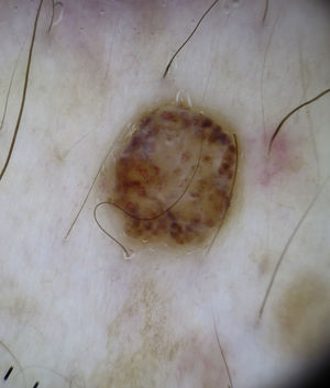 Cutaneous melanoma satellitosis with corkscrew vessels.