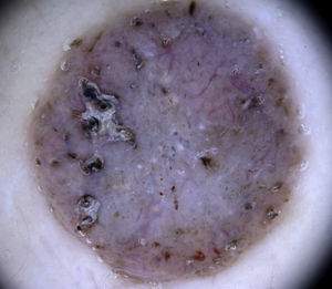 Hairpin vessels in seborrheic keratosis.