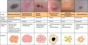 Vascular patterns in keratinizing tumors, sebaceous hyperplasia/molluscum contagiosum, and dermatofibroma.