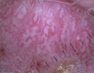 Dotted vessels in the typical string of pearls arrangement seen in clear-cell acanthoma.