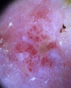 Bowen disease, glomerular vessels in a clustered distribution.