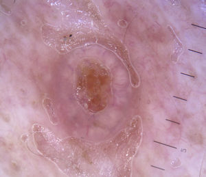 Crown vessels in a typical sebaceous hyperplasia lesion.