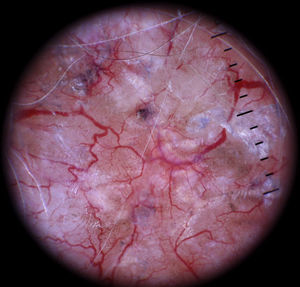 Bright red arborizing telangiectasias in sharp focus; a typical finding in basal cell carcinoma.