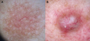Arborizing telangiectasias in lesions other basal cell carcinoma. A, Telangiectasia macularis eruptiva perstans. B, Adnexal tumor.