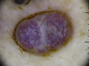 Rainbow pattern in Kaposi sarcoma.