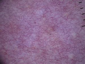 Vessels in normal skin; note the dotted vessels corresponding to the papillary dermal vessels and the network of vessels corresponding to the upper dermal plexus.