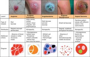 Vascular patterns in vascular lesions and Kaposi sarcoma.
