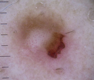 Dotted vessels in a dermatofibroma.