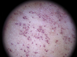 Oval lacunae characteristic of angioma serpiginosum.