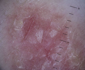 Dotted vessels combined with a scaling surface in a typical psoriatic plaque.