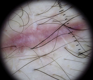 Dilated vessels in a string-like distribution in the center of a scar.