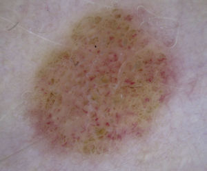Intradermal melanocytic nevus with comma vessels scattered throughout the lesion.