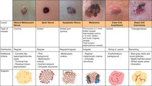 Vascular patterns seen in melanocytic lesions, clear-cell acanthoma, and basal cell carcinoma.