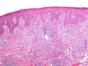 Typical image of type A lymphomatoid papulosis. Note the characteristic large-cell, wedge-shaped infiltrate (hematoxylin-eosin, original magnification ×10).
