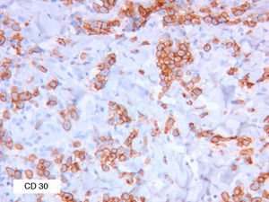 Intense CD30 positivity in type A lymphomatoid papulosis (CD30, original magnification ×30).