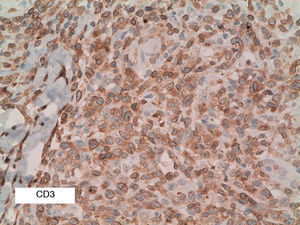 CD3 positivity in the large cells of type A lymphomatoid papulosis (CD30, original magnification ×30).