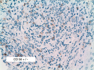 Section of the only biopsy in which doubtful CD56 positivity was detected in some cells (CD56, original magnification ×30).