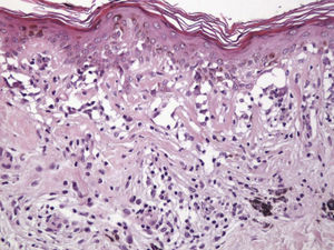 Laminar fibrosis mainly in the papillary dermis. Hematoxylin-eosin, original magnification ×200.