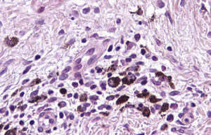 High-power field showing melanophages. Hematoxylin-eosin, original magnification ×400.