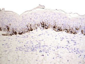 Residual melanocytic lentiginous hyperplasia, which was detected in few cases. Melan-A, original magnification ×200.