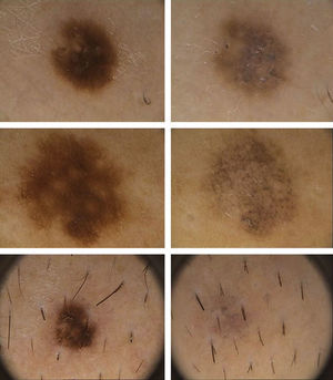 The principal dermoscopic feature associated with very rapid regression of melanocytic nevi was the marked presence of melanophages and the disappearance of the structural pattern that had been evident on earlier dermoscopy.