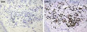 CD8+ T cells predominated in this inflammatory infiltrate. Immunoperoxidase, original magnification ×400.