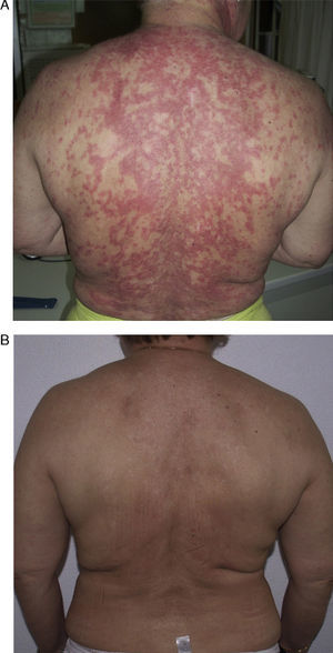 A, Patient with extensive subacute cutaneous lupus erythematosus lesions before starting therapy with rituximab. B, The patient is lesion-free 8 months after her fourth cycle of rituximab.