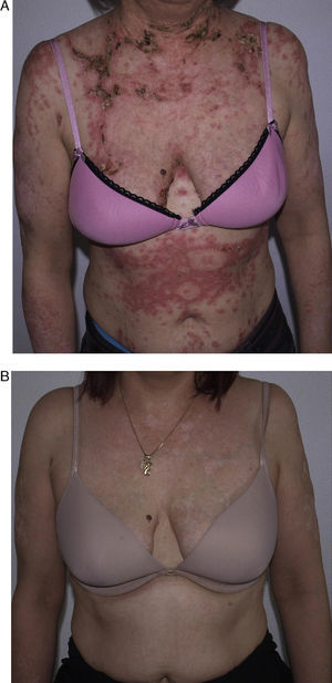 A, Patient with extensive crusted subacute cutaneous lupus erythematosus lesions before starting therapy with rituximab. B, The patient is lesion-free 8 months after her second cycle of rituximab.