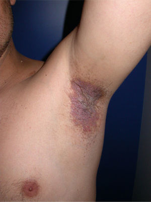 Erythematous-violaceous plaques and erosions in the axilla in a patient with Hailey-Hailey disease before treatment with botulinum toxin.