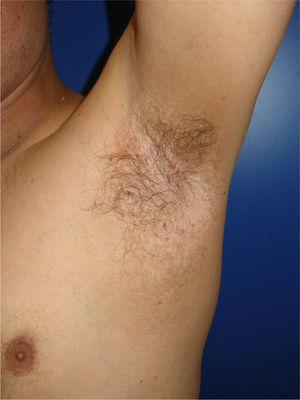 Clinical resolution of the cutaneous symptoms after injection of botulinum toxin.