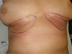 Erythematous-violaceous plaques and erosions in the submammary folds. The image shows the outlined area to be treated, including affected areas and areas at risk of becoming affected.