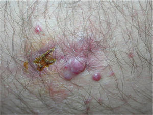 Pyogenic granulomas of different sizes, 1 biopsied, around the scar from the primary lesion on the thigh.