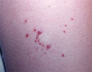 Vascular-appearing papules on the periphery of the scar from shave excision of the primary pyogenic granuloma.