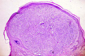 Lobular proliferation of capillaries with epidermal collarette at the periphery (hematoxylin-eosin, ×40).
