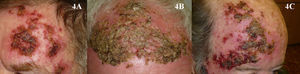 A-C. Local reaction at week 4 of treatment with imiquimod for multiple actinic keratoses.