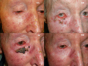 Superficial basal cell carcinoma on the right lower eyelid treated with imiquimod. A, Prior to treatment. B, Local reaction and mild conjunctivitis after 3 weeks of treatment. C, Local reaction and mild conjunctivitis after 6 weeks of treatment. D, Clinical response and resolution of conjunctivitis 1 month after completion of treatment with imiquimod.