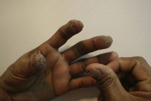 Fingertip dermatitis after handling garlic.