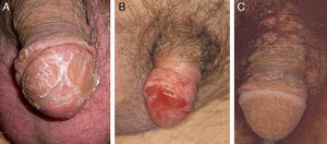 Appearance of premalignant or in situ lesions. A, pseudoepitheliomatous micaceous balanitis. B, Erythroplasia of Queyrat. C, Bowenoid papulosis.