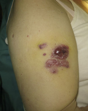 Clinical image of the reddish-purple lesions on the anterior surface of the right arm.