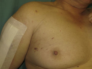 Clinical image of the erythematous-violaceous lesions on the outer quadrants of the right breast.